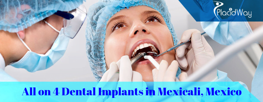 All on 4 Dental Implants in Mexicali, Mexico