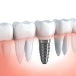 are-dental-implants-right-for-me2 are-dental-implants-right-for-me2